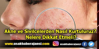 Akne ve Sivilcelerden Nasıl Kurtuluruz? Nelere Dikkat Etmeli?